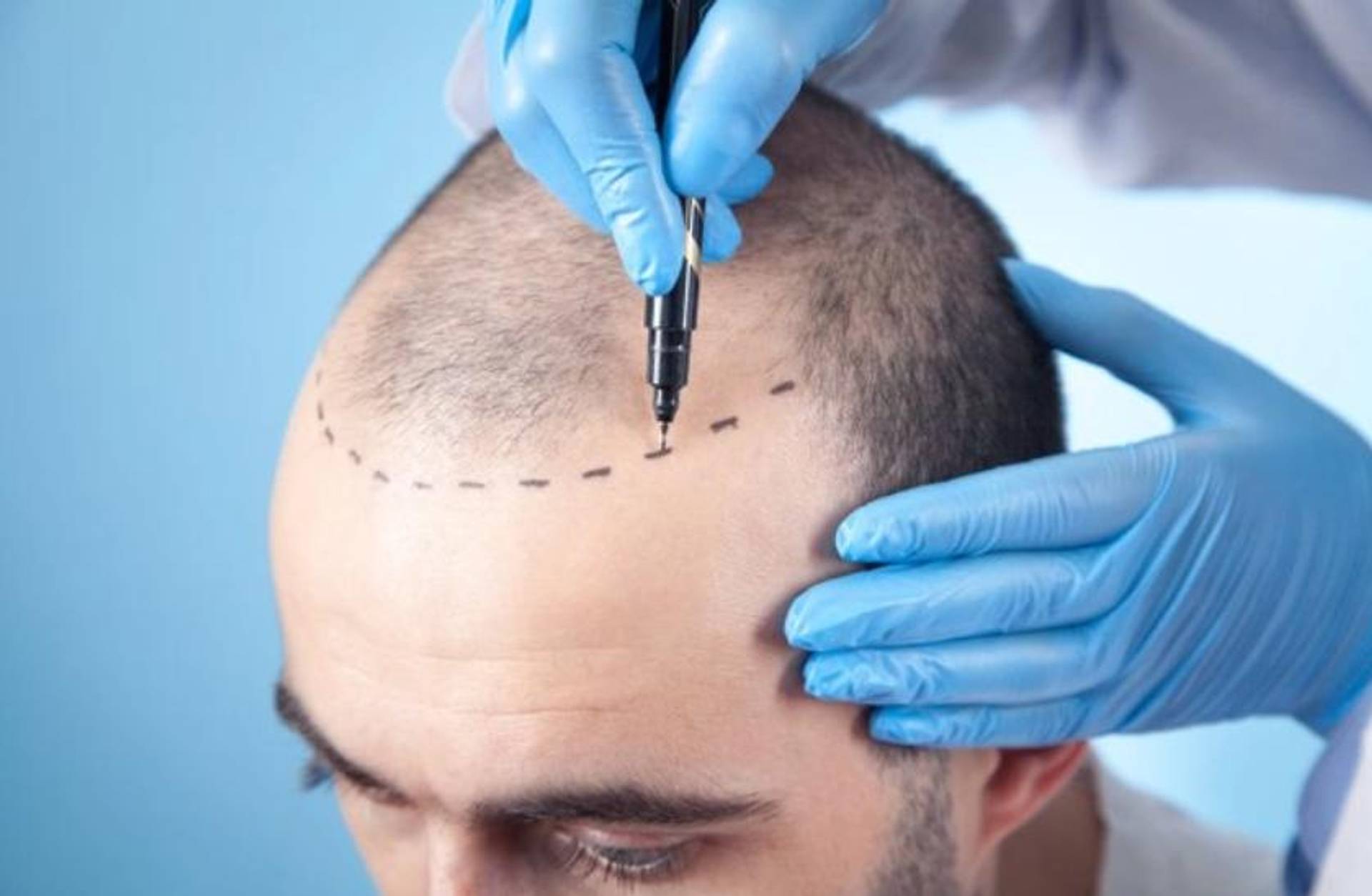 Hair Transplant