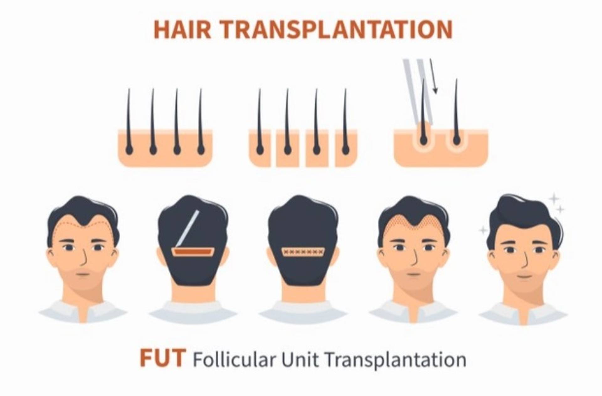 FUT Transplantation