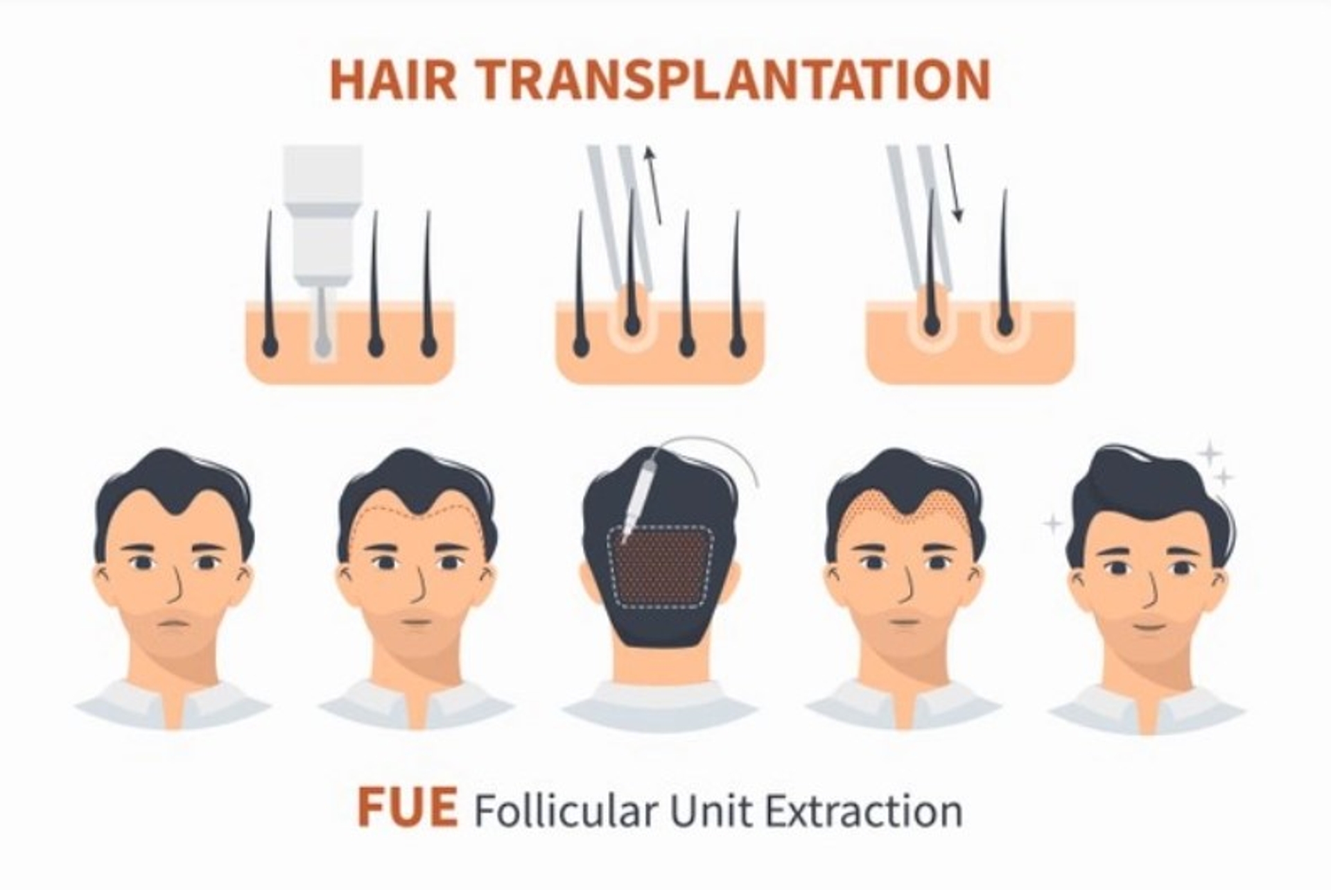 Fue Hair Transplant thumbnail